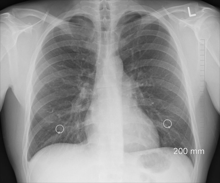 Que faire quand une fracture des côtes 7 et 8 est diagnostiquée ?